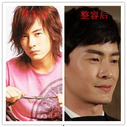 男明星整容失败,颜值巅峰变惊悚现场，揭秘失败案例背后的真相